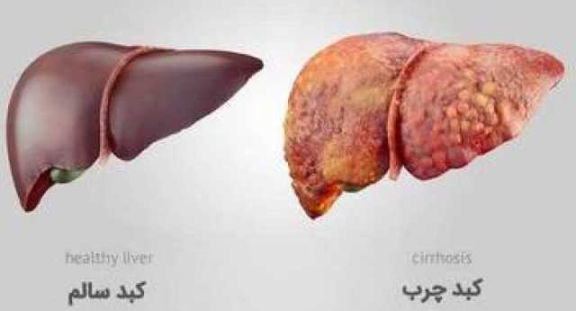 خوراکی‌های مفید و مضر برای کبد را بشناسید