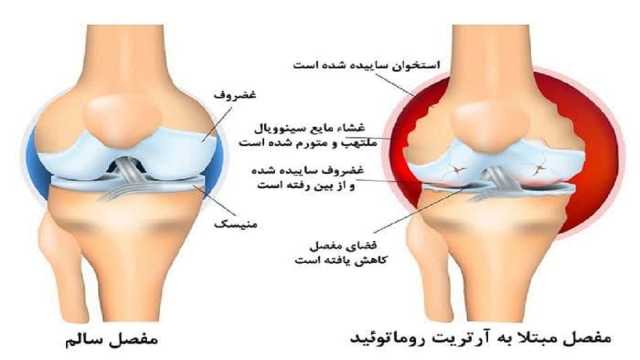 کنترل و کاهش عوارض بیماری روماتیسم مفصلی با مصرف غذا‌های ضدالتهاب