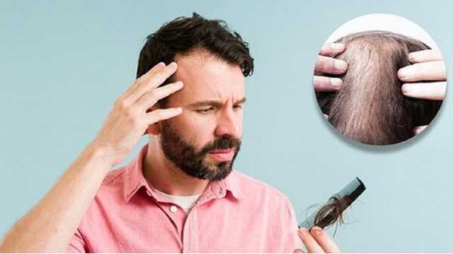 دلیل ریزش موی سکه‌ای چیست؟