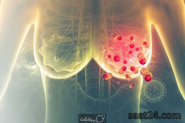 سرطان پستان | علائم سرطان سینه | نحوه درمان سرطان پستان